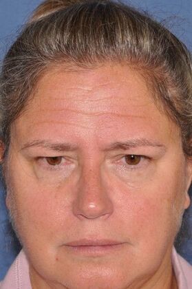 Endoscopic Browlift: Endo Browlift, upper and lower lids 1 year - Before