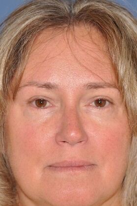 Endoscopic Browlift: Endo Browlift, upper and lower lids 1 year - After