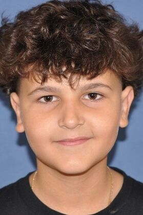 Otoplasty Otoplasty in a young man - After