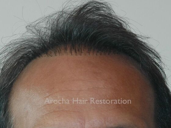 Corrective Hair Restoration Case 6 - Before