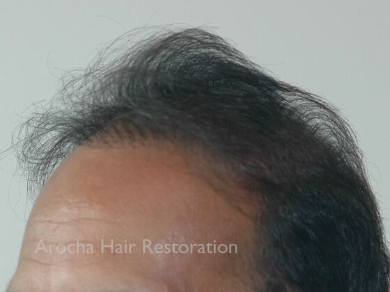 Corrective Hair Restoration: Case 6 - Before
