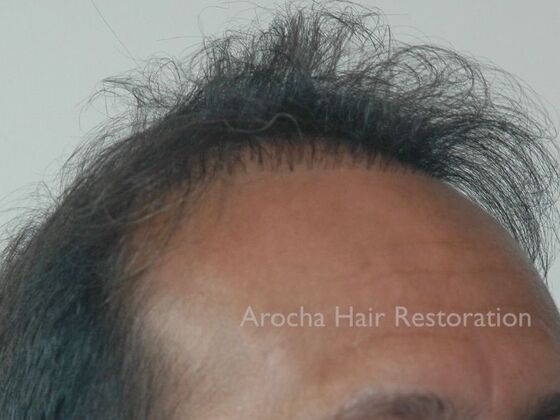 Corrective Hair Restoration: Case 6 - Before