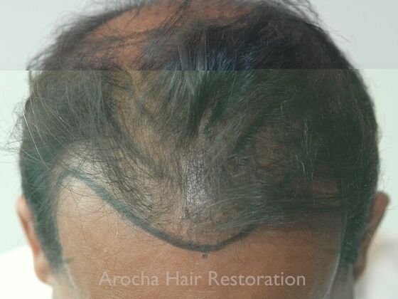 Corrective Hair Restoration: Case 6 - Before