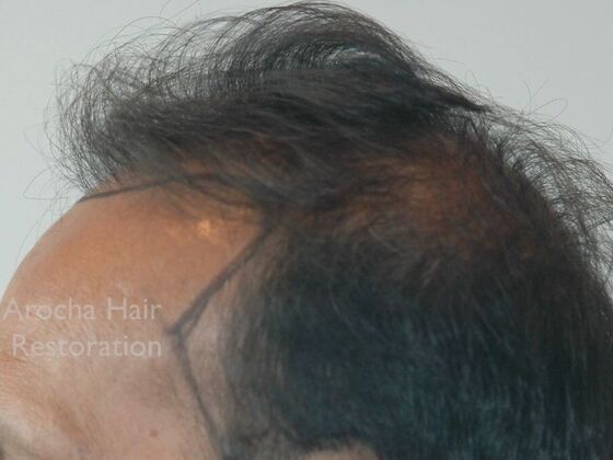 Corrective Hair Restoration: Case 6 - Before