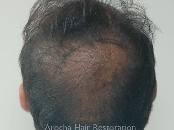 Corrective Hair Restoration: Case 6 - Before