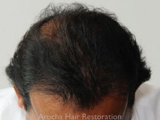 Corrective Hair Restoration: Case 6 - After