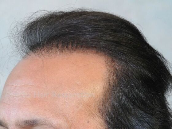 Corrective Hair Restoration: Case 6 - Before