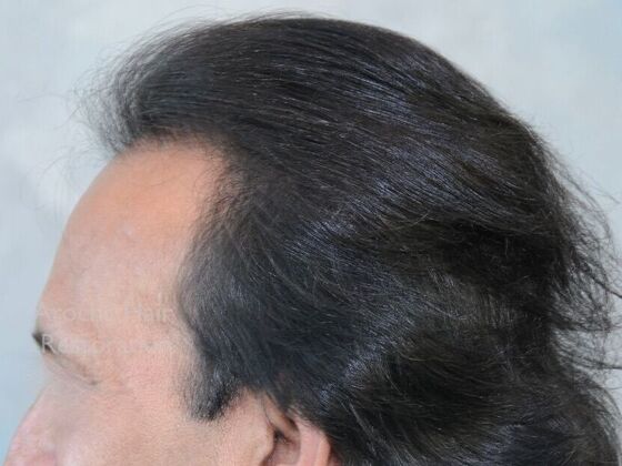 Corrective Hair Restoration: Case 6 - After
