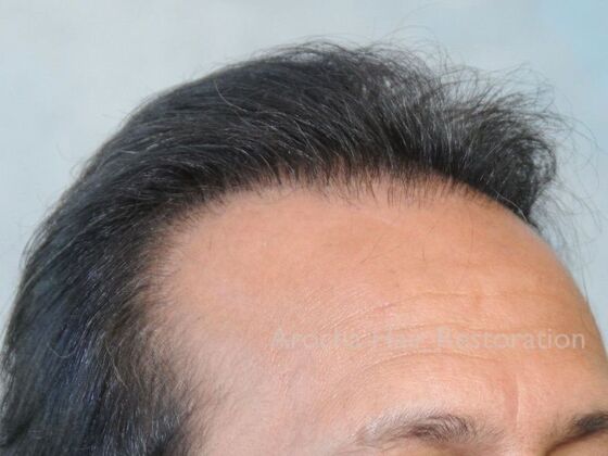 Corrective Hair Restoration: Case 6 - After