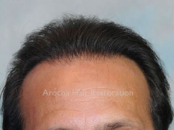 Corrective Hair Restoration Case 6 - After
