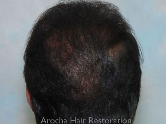 Corrective Hair Restoration: Case 6 - After