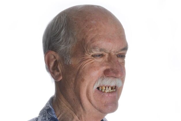 Our Results: UPPER-LOWER ALL ON 6 THEETH IN A DAY - Before