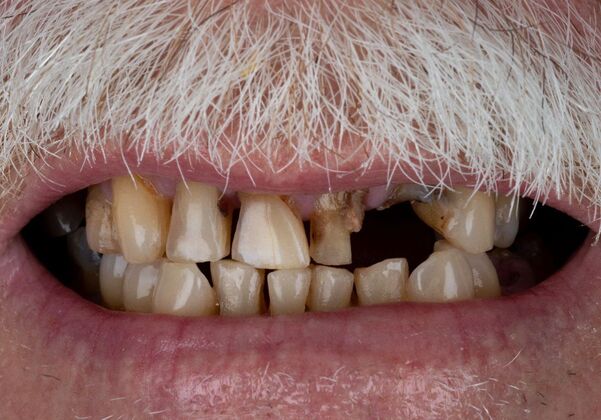 Our Results: UPPER-LOWER ALL ON 6 THEETH IN A DAY - Before