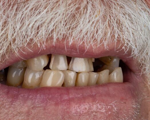 Our Results: UPPER-LOWER ALL ON 6 THEETH IN A DAY - Before