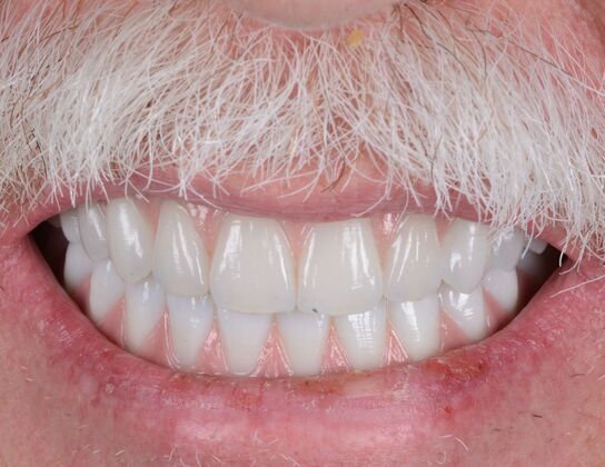 Our Results: UPPER-LOWER ALL ON 6 THEETH IN A DAY - After