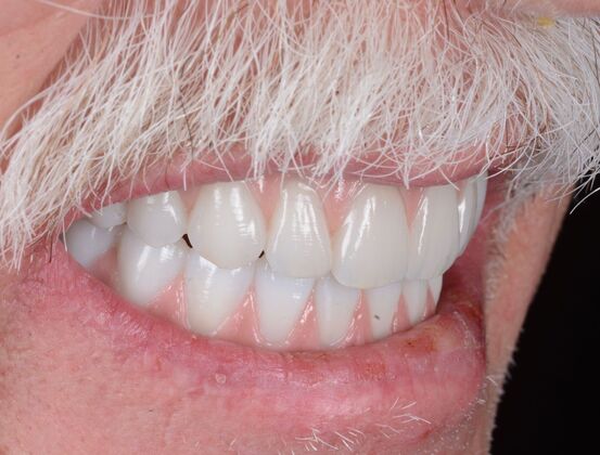 Our Results: UPPER-LOWER ALL ON 6 THEETH IN A DAY - After