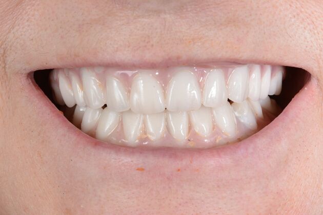 Our Results: All on 6 uppeer and lower patient, - interim restaorations performed the same surgery day