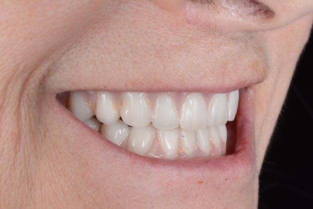 Our Results: All on 6 uppeer and lower patient, - After