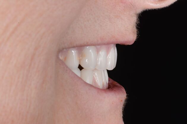 Our Results: All on 6 uppeer and lower patient, - after surgery same day teeth lower fixed temps