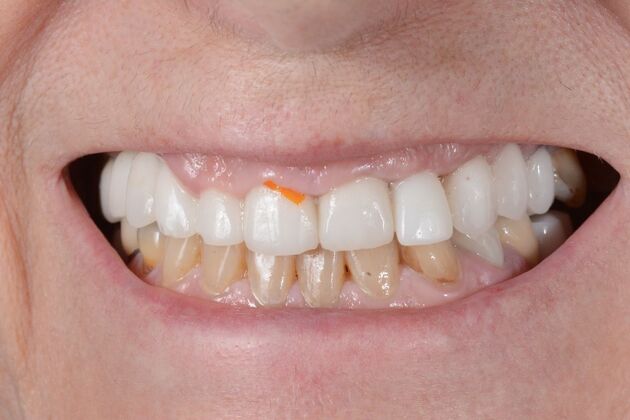 Our Results: All on 6 uppeer and lower patient, - Before