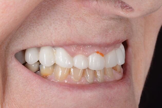 Our Results: All on 6 uppeer and lower patient, - Before