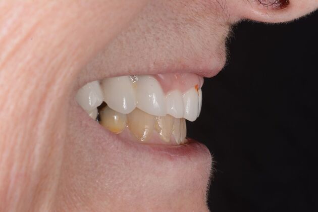 Our Results: All on 6 uppeer and lower patient, - Before