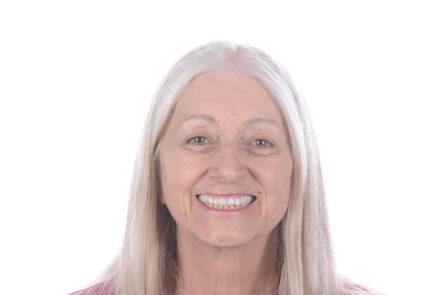 Our Results All on 6 uppeer and lower patient,  - Before