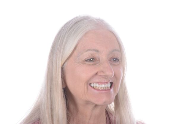 Our Results: All on 6 uppeer and lower patient, - Before