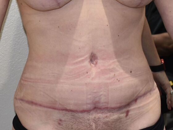 Tummy Tuck (Abdominoplasty): Case 489 - After