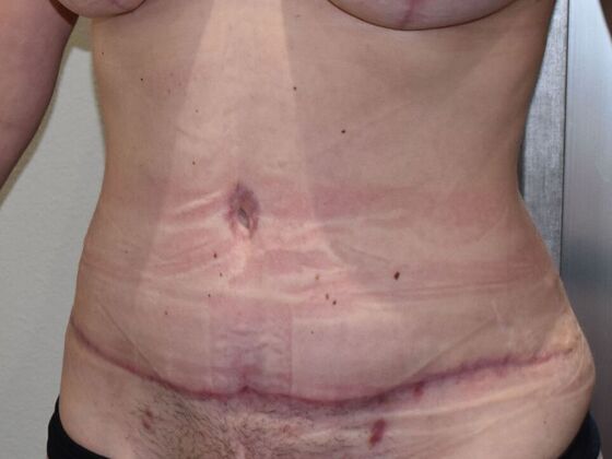 Tummy Tuck (Abdominoplasty): Case 489 - After