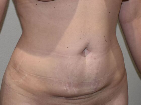 Tummy Tuck (Abdominoplasty): Case 489 - Before