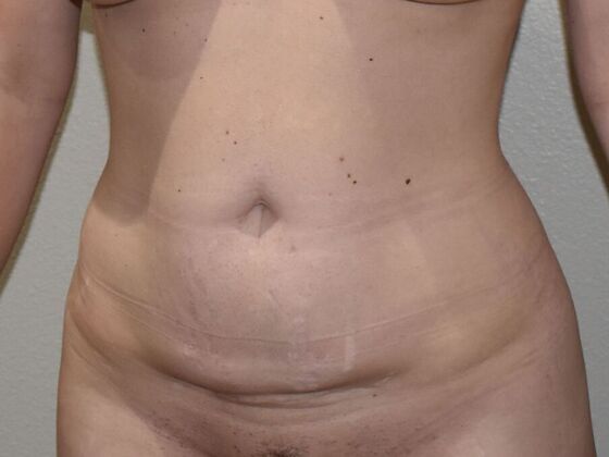 Tummy Tuck (Abdominoplasty): Case 489 - Before