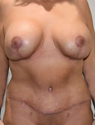 Mommy Makeover Case 313 - After