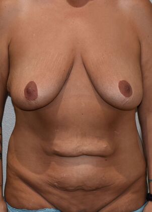 Mommy Makeover Case 313 - Before