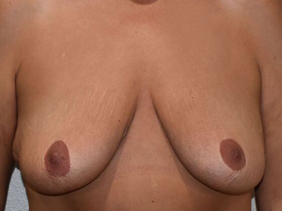 Breast Augmentation w/ Lift Case 539 - Before