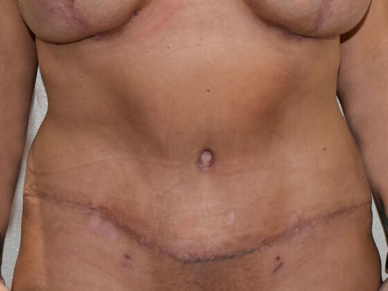 Tummy Tuck (Abdominoplasty): Case 490 - After