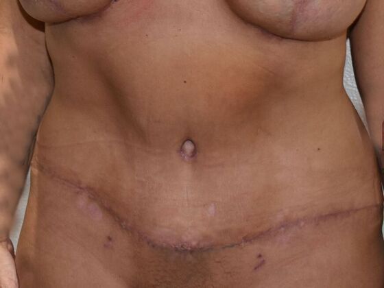 Tummy Tuck (Abdominoplasty): Case 490 - After