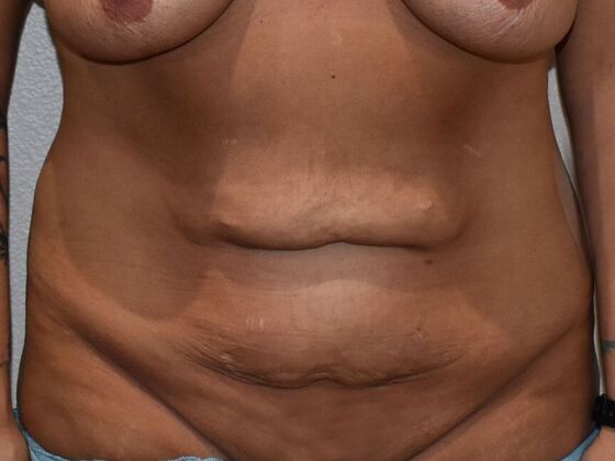 Tummy Tuck (Abdominoplasty): Case 490 - Before