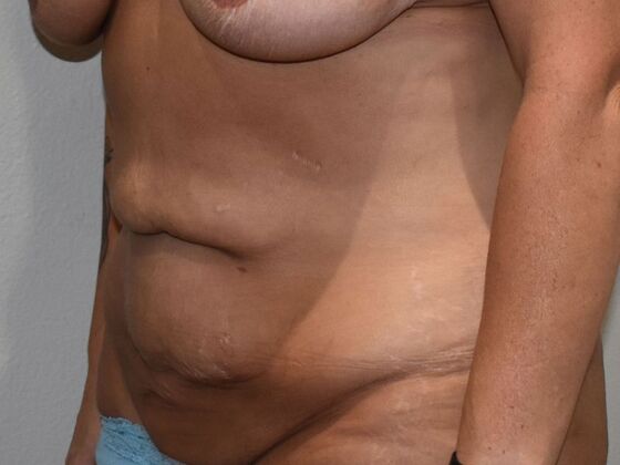 Tummy Tuck (Abdominoplasty): Case 490 - Before