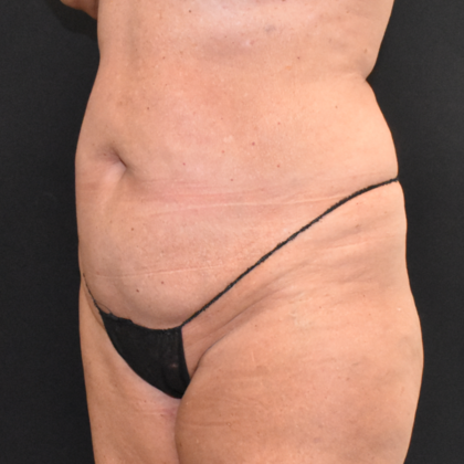 Abdominoplasty: Case 14 - Before