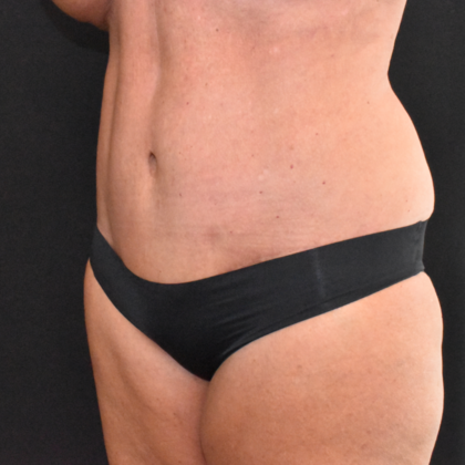 Abdominoplasty: Case 14 - After