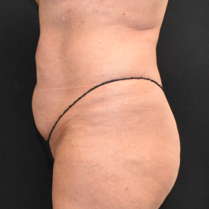 Abdominoplasty: Case 14 - Before