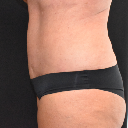 Abdominoplasty: Case 14 - After