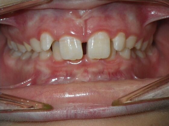 Orthodontic treatment in Phases: Case 12 - Before