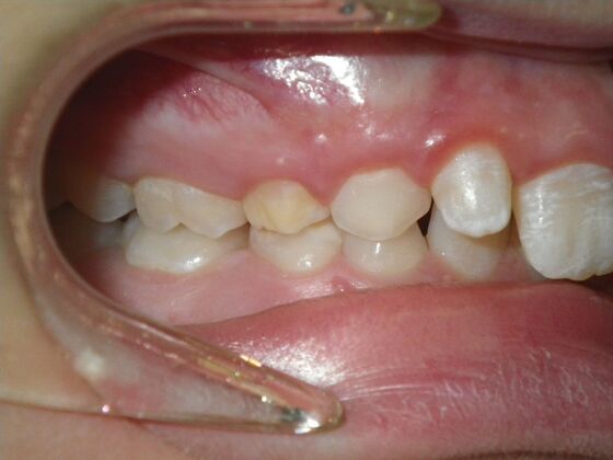 Orthodontic treatment in Phases: Case 12 - Before
