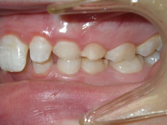 Orthodontic treatment in Phases: Case 12 - Before