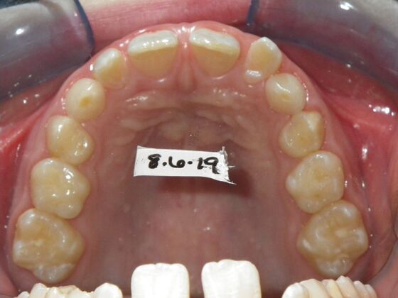 Orthodontic treatment in Phases: Case 12 - Before