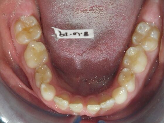 Orthodontic treatment in Phases: Case 12 - Before