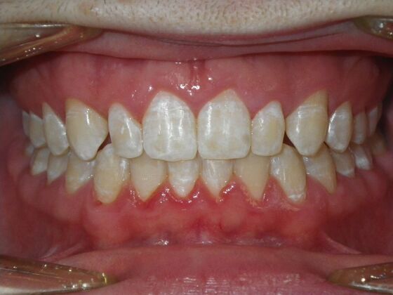 Orthodontic treatment in Phases: Case 12 - After