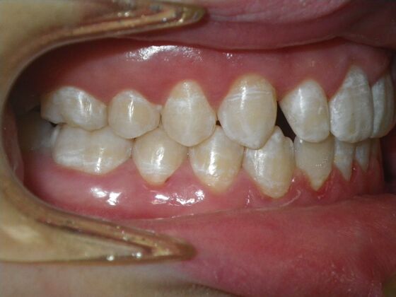 Orthodontic treatment in Phases: Case 12 - After